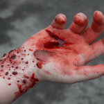 Blutige hand FFW Uebung